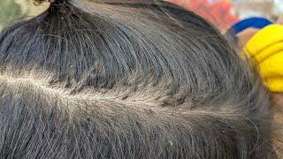 Remove thousand lice from black hair - Getting out all head lice from hair