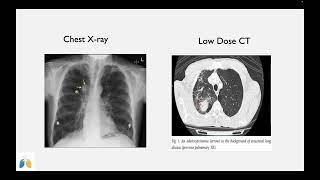 Saving Lives Through Early Detection: Lung Cancer Screening (May 2023)