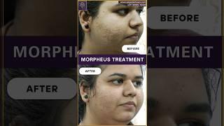 Morpheus 8 | Morpheus Treatment Before After | Morpheus Treatment for acne Scars #acnescars #acne