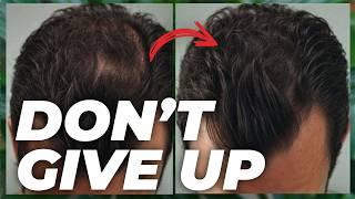 5 Finasteride Alternatives - Watch This if You CANT Use Finasteride