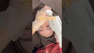 【美容整形】医療HIFUはとても効果的です#shorts