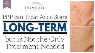 PRP can be Effective for Acne Scar Treatment When Combined with Other Procedures