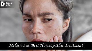 MELASMA OR CHLOASMA | Causes and Best Homeopathic Treatment - Dr. V. Bhagyalakshmi | Doctors' Circle