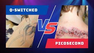 Picosecond  VS  Q Switched Lasers , What's The Difference?