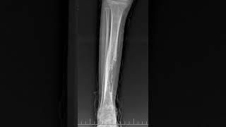 Chronic Osteomyelitis: Causes, Symptoms & Treatment Explained!" #chronicosteomyelitis, #radiology