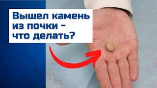 Вышли камни из почки? Анализ камня почки и метафилактика