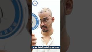 Best Hair Transplant in Pune | Big FUE Grade 4 | 3240 Grafts | Cost of Hair Transplant in Pune