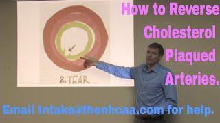 How to Unblock Cholesterol Plaqued Arteries