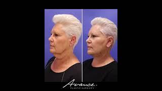 67-Year-Old Patient Mini Face/Necklift Results | Avance Plastic Surgery Institute: Dr. Erez Dayan