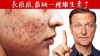 長痘痘,最缺一種維生素？自然療法,柏格醫生 Dr Berg