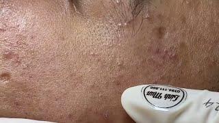 Acne treatment for Spa Linh Mun 2024 #137