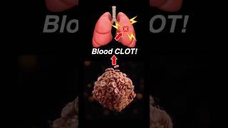 Doctor Explains: PULMONARY EMBOLISM 🫁