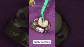 Dental Filling #shorts  #dentist  #asmr