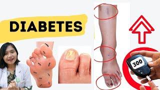 13 SIGNS ON THE FEET WHEN HIGH BLOOD SUGAR | SYMPTOMS OF DIABETES IN THE FEET | dr.Emasuperr