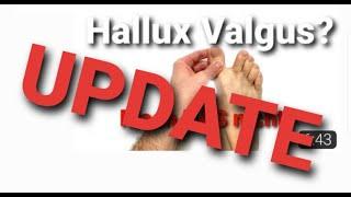 Update Hallux Valgus