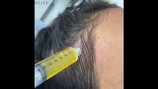 Vampire PRP Hair Restoration | Know About This Amazing Treatment | Elite Aesthetics