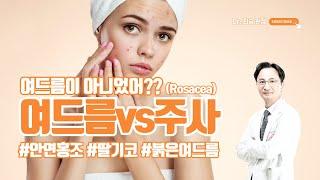 #여드름 vs #주사 #Rosacea 제대로 구분하기 #닥터최승 #청담노엘의원 #노엘의원 #청담동피부과 #청담동여드름 #청담동주사