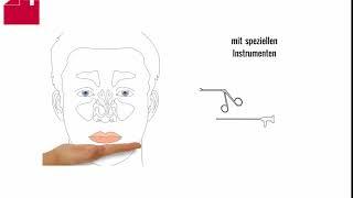 Nasen OP | Nasenscheidewand OP | Septumplastik