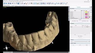 BSP4.12: Extracting a Tooth from A Model While Retaining the Emergence Profile