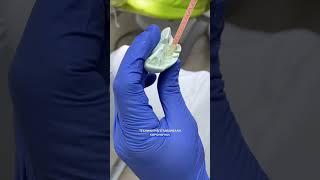 Это реально?? Восстановление ЗУБОВ за 1 день CEREC #имплантация_зубов #зубные_импланты