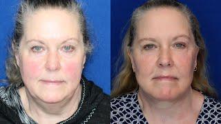 Stunning Neck Lift Results | Vertical Restore Face Lift!