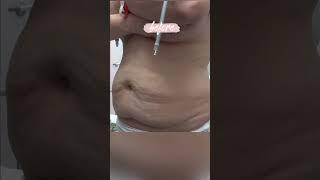 Tummy Tuck with Liposuction Before and Immediately After! #tummytuckbeforeandafter