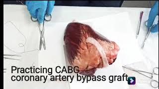 ||Coronary artery bypass surgery||  ||Practice|| ||Submucosa|| ||Medical Student Life Fun||