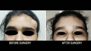 FOREHEAD MASS / LUMP/SWELLING - HIDDEN SCAR SURGERY -  Dr VICKY JAIN PLASTIC AND COSMETIC SURGEON