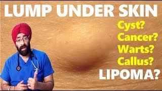 LUMP UNDER SKIN : LIPOMA, Cysts, Cancer, Warts, Callus, Moles, Corns | Dr.Education
