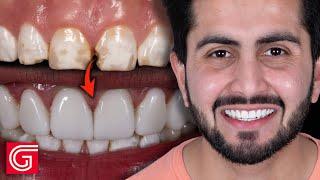 HOW TO Deliver 10 Cosmetic Veneers for Enamel Hypoplasia Patient