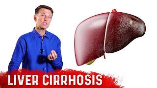 Is Liver Cirrhosis Reversible? -  Fibrosis vs. Cirrhosis – Dr.Berg