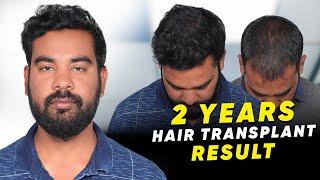 Hair Transplant in India | Best Results & Cost of Hair Transplant in India