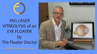 YAG Laser Treatment - Vitreolysis -  of an Eye Floater by Dr. James Johnson 'The Floater Doctor'