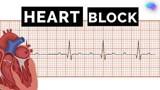 Heart Block | AV Block | ECG | EKG | OSCE Guide | UKMLA | CPSA | PLAB 2