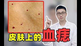 【皮肤科医生】皮肤上长小血痣，血液病？肝不好？