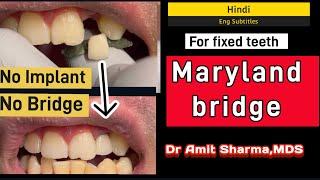 NO IMPLANT, NO BRIDGE | Maryland bridge replacing missing front teeth