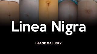 Linea Nigra: Image Gallery