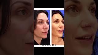 Rhinoplasty Before And After | Avance Plastic Surgery Institute: Dr. Erez Dayan | Reno, NV
