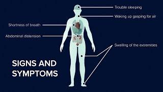 What is Heart Failure? Causes, Symptoms and Treatment