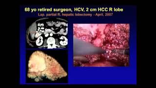 Outcomes of laparoscopic liver surgery