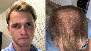 BALDING Through My 20's - Its Time To SHAVE My HEAD BALD