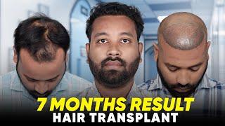 Hair Transplant in Bangalore | Best Results & Cost of Hair Transplant in Bangalore