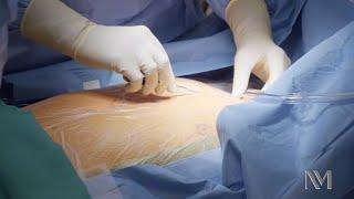 Open Heart Surgery | Inside the OR
