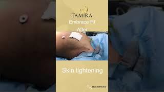 Embrace RF skin tightening