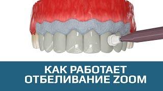 Отбеливание зубов. Процедура отбеливания зубов ZOOM 3