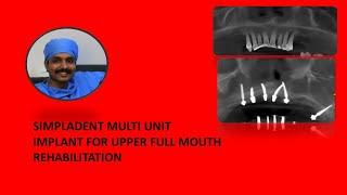SIMPLADENT MULTI UNIT IMPLANT FOR UPPER FULL MOUTH REHABILITATION