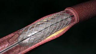 Coronary Artery Angioplasty ( Radial Access)