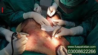 Body hair transplant by dr M jawad chaudhry & Dr sabahat jan