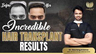 Incredible Hair Transplant Results | Medlinks