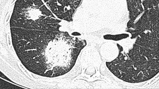 Halo and reverse halo sign CT chest